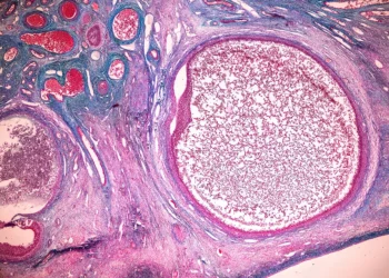 Estudio israelí: Nanofármacos de ARN detiene el cáncer de ovario