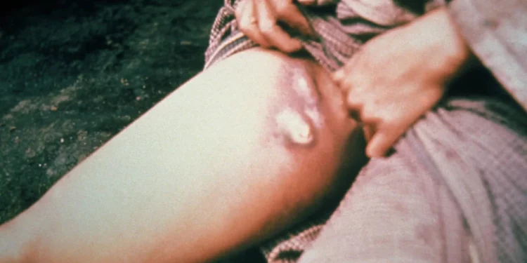 Científicos hallan pruebas de la peste bubónica en la Antigua Inglaterra