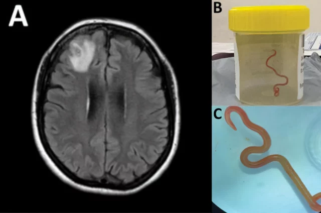 Descubren un gusano parásito en el cerebro de mujer de 64 años
