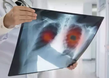 Estudio israelí podría prevenir recaída en cáncer de pulmón