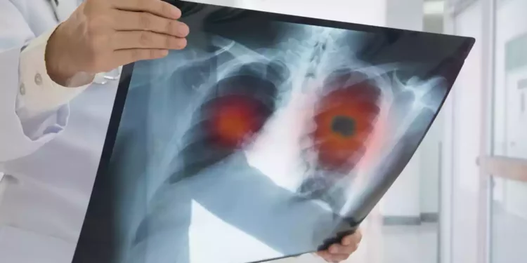 Estudio israelí podría prevenir recaída en cáncer de pulmón