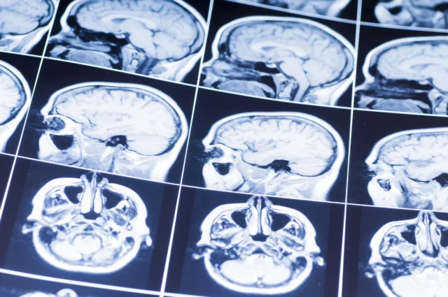 Dispositivo de Insightec mejora administración de fármacos Alzheimer
