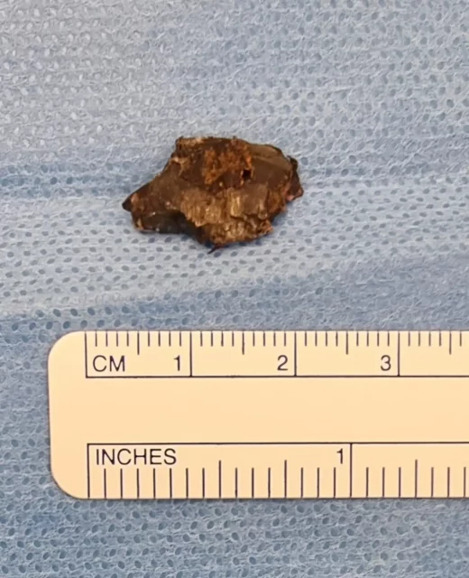Metralla de 188 mm extraída de niño herido en Majdal Shams