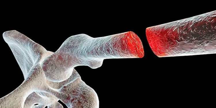 PeptOss: avance israelí que combina regeneración ósea y terapia