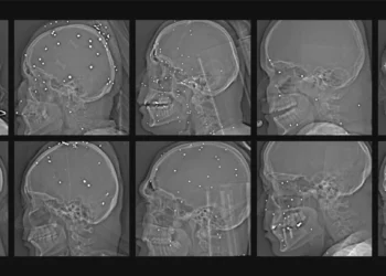 Radiografías demuestran disparos deliberados contra órganos vitales de manifestantes en Irán