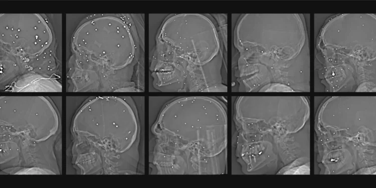 Radiografías demuestran disparos deliberados contra órganos vitales de manifestantes en Irán