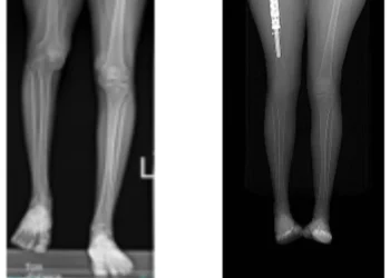 Hadassah reconstruye y alarga una pierna con implantes 3D en Israel