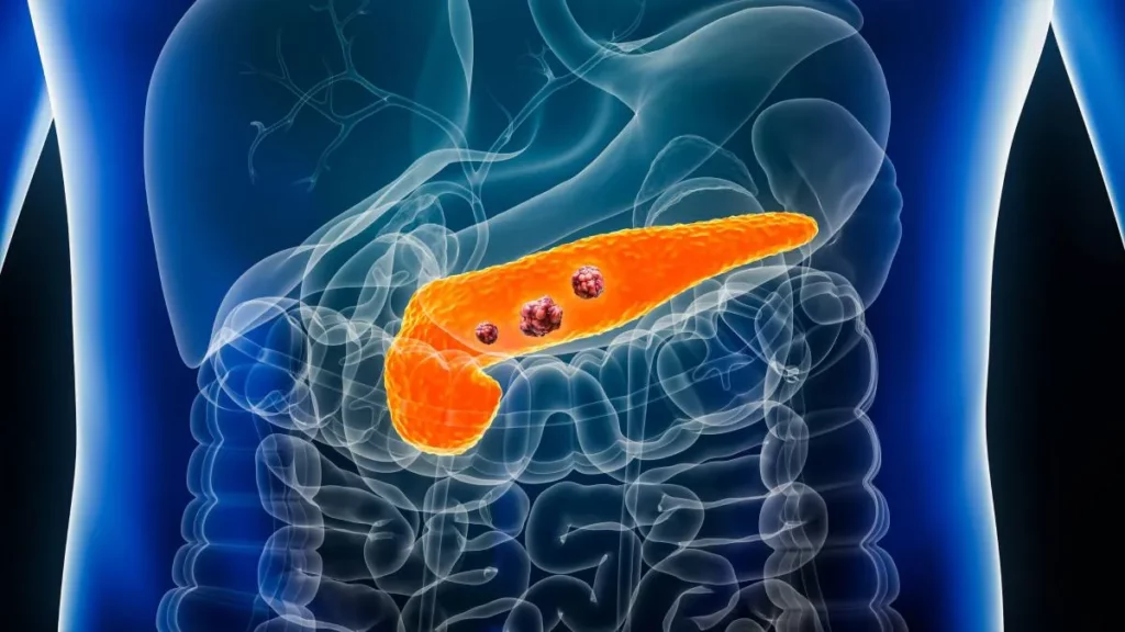 Cáncer de páncreas: Científicos de Israel identifican un inhibidor selectivo