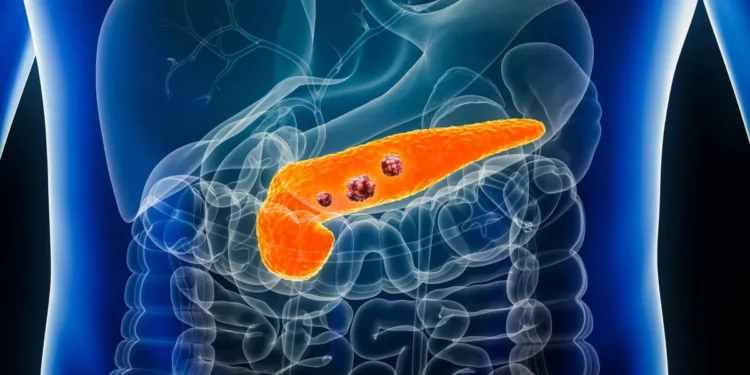 Cáncer de páncreas: Científicos de Israel identifican un inhibidor selectivo