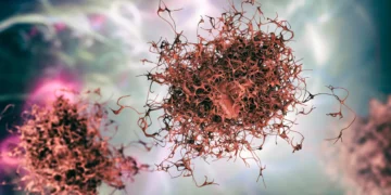 Moderna: Vacuna de ARNm ayuda a evitar la reaparición del melanoma