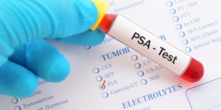 Ilustración del cáncer de próstata